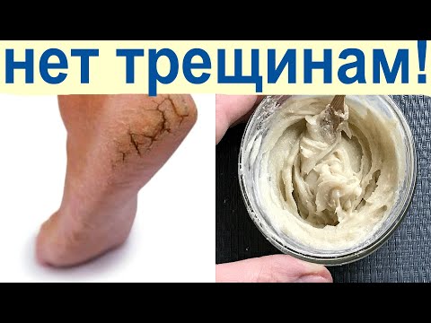 Лечение трещин на пятках в домашних условиях