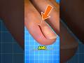 🚨 Why You Should NEVER Rip Off a Hangnail