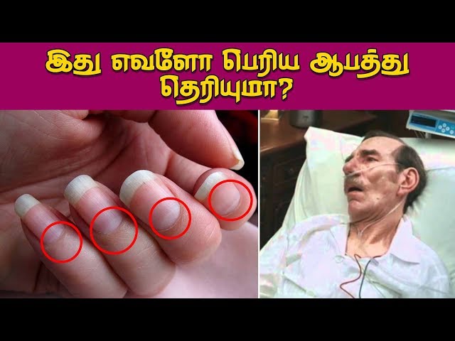 நகத்தில் சொத்தை இருக்கா? இதை செய்யுங்கள் உடனே சரியாகிவிடும் |nail fungus  home remedies - YouTube