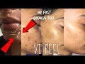 MY FIRST CHEMICAL PEEL! | VI PEEL To Treat ACNE & Remove Dark Spots / Hyperpigmentation