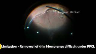 Paediatric RD - PVR: PFCL for PVD-Use &amp; Limitations