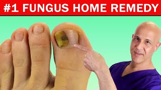 #1 Best Home Remedy Cure for Toenail Fungus!  Dr. Mandell Resimi