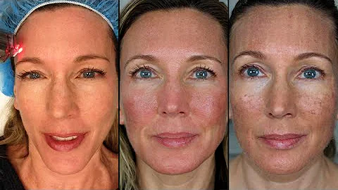 My Fraxel Dual Laser Experience | Procedure & Recovery Vlog