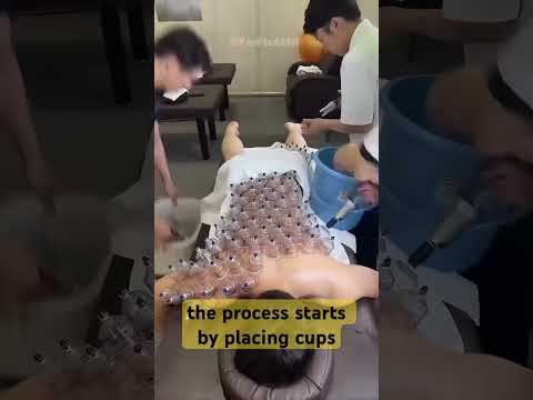Cupping therapy for muscle recovery #muscle #gym #musclerecovery