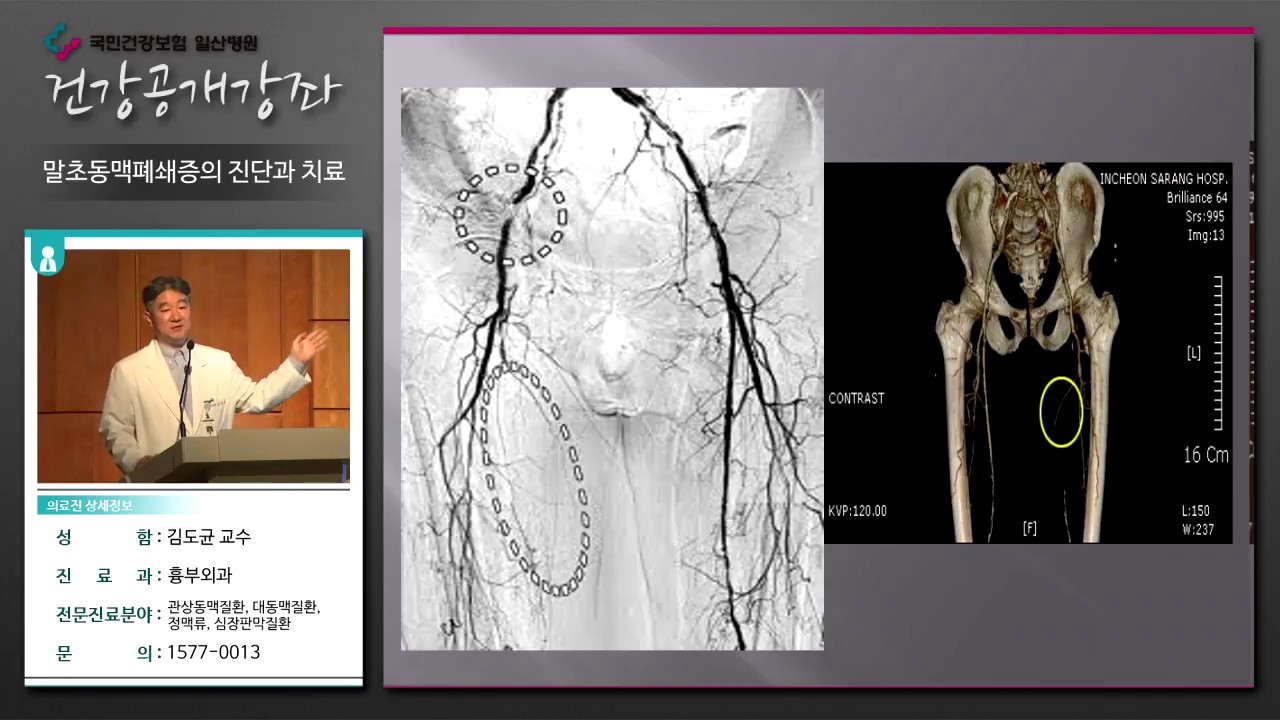 [ 국민건강보험 일산병원 건강강좌] 말초동맥폐쇄증의 진단과 치료