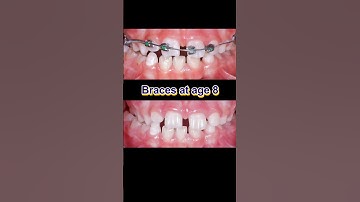 Braces at age 8. Fix gapped teeth #braces #dentist #orthodontist
