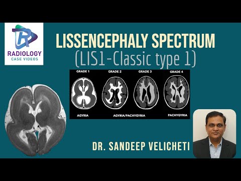 Lissencephaly Spectrum#Klasický typ1#Sandeep VelichetI#pochopenie lissencephaly mikroskopickej úrovne