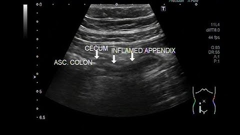 Ultrasound Video showing scanning of Inflamed Appendix.