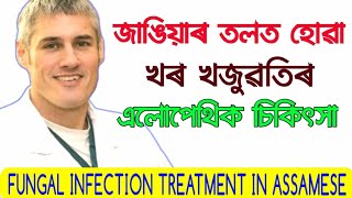 খৰ খজুৱতিৰ এলোপেথিক চিকিৎসা | | Treating Fungal Infection | | Fungal Ringworm Infection