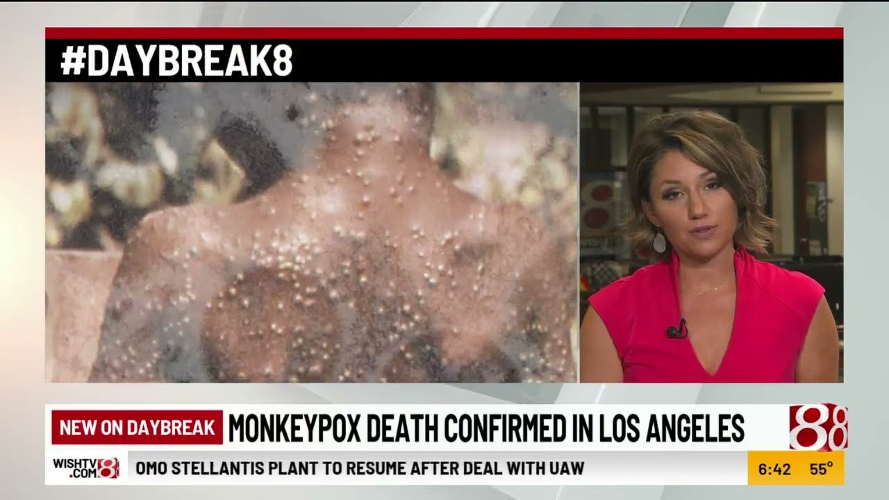 First U.S. monkeypox death confirmed in Los Angeles County - YouTube