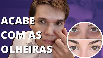 Como acabar com as olheiras vasculares?