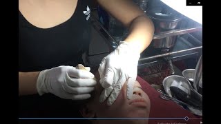 [ Acne treatment Hương official ] Treating hidden acne, bran acne