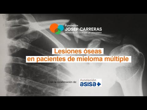 Vídeo: 4 maneres de gestionar el dolor de mieloma múltiple