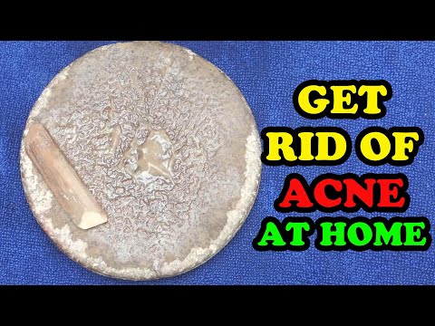 HOW TO REMOVE PIMPLES IN  DAYS | BEST FACE PACK FOR PIMPLE TREATMENT | ACNE ACNE SCAR REMOVAL