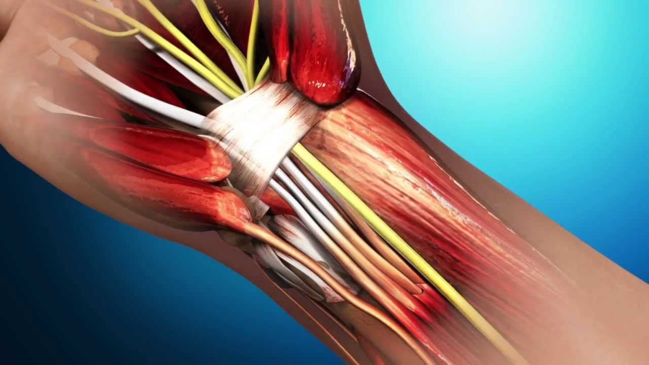 Introducing iGO neverstop's Revolutionary Keo Brace YouTube