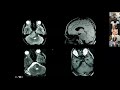 Versatility of the lateral supracerebellar approach  neurosurgical tv