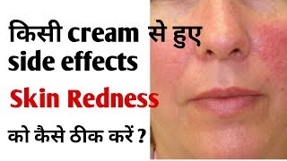 किसी Cream के Side effect या face Redness को कैसे ठीक करें