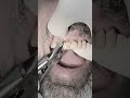 Extraction of anterior remaining lateral incisor root #dentist #dental #dentistry #dentista #teeth