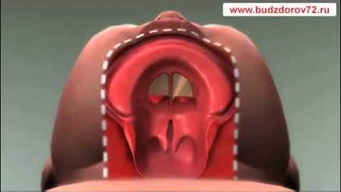 CLEFT LIP AND PALATE ANIMATION