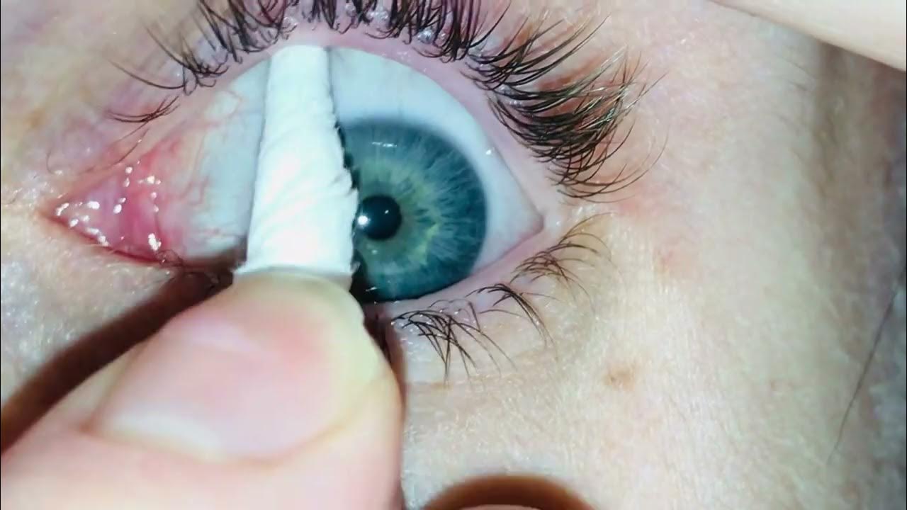 Eye mucous fishing syndrome YouTube