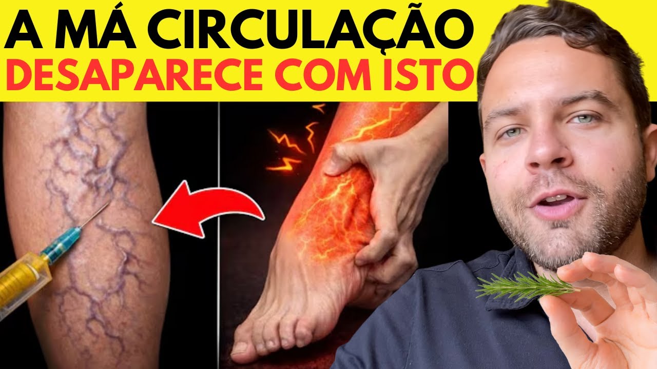 CURE as VARIZES das PERNAS com ESSE SEGREDO  (MELHORA CIRCULAÇÃO!)