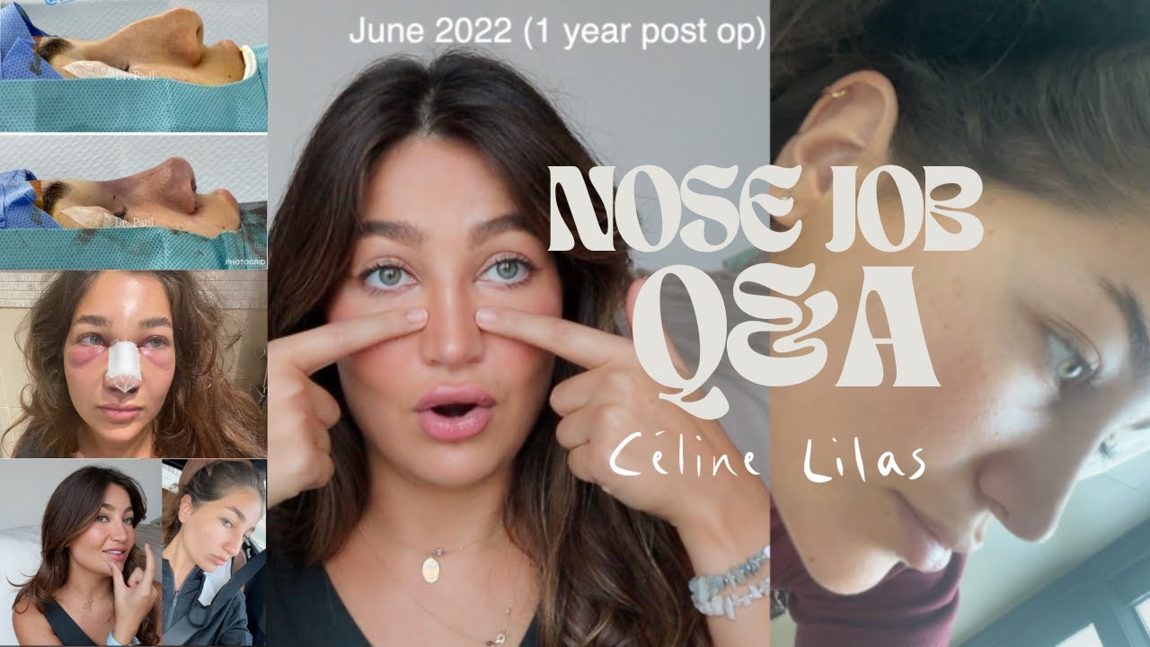 FULL *NATURAL* NOSE JOB EXPERIENCE IN DUBAI 2 YEAR POSTOP, PLANNING