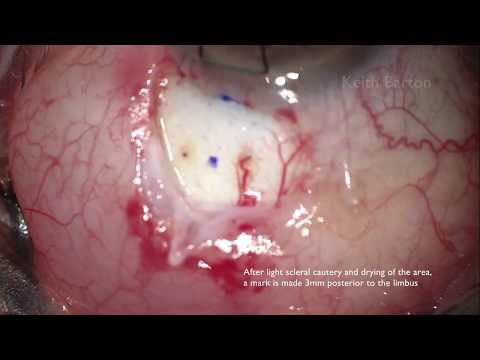 Vidéo: Implantation Ab Externo Du MicroShunt, Un Dispositif Chirurgical En Poly (bloc De Styrène-isobutylène-bloc-styrène) Pour Le Traitement Du Glaucome Primitif à Angle Ouvert: Une Revu