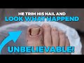 HE TRIMMED HIS NAIL THE WRONG WAY!