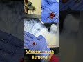 Surviving Wisdom Tooth Removal: What to Expect! #WisdomTeeth #DentalSurgery #OralHealth #Recovery