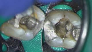 Molar Challenge - Ledged Canals 4K