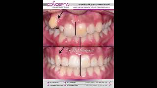 درمان ارتودنسی ثابت دو فک بدون کشیدن دندان | کلینیک تخصصی دندانپزشکی کانسپتا