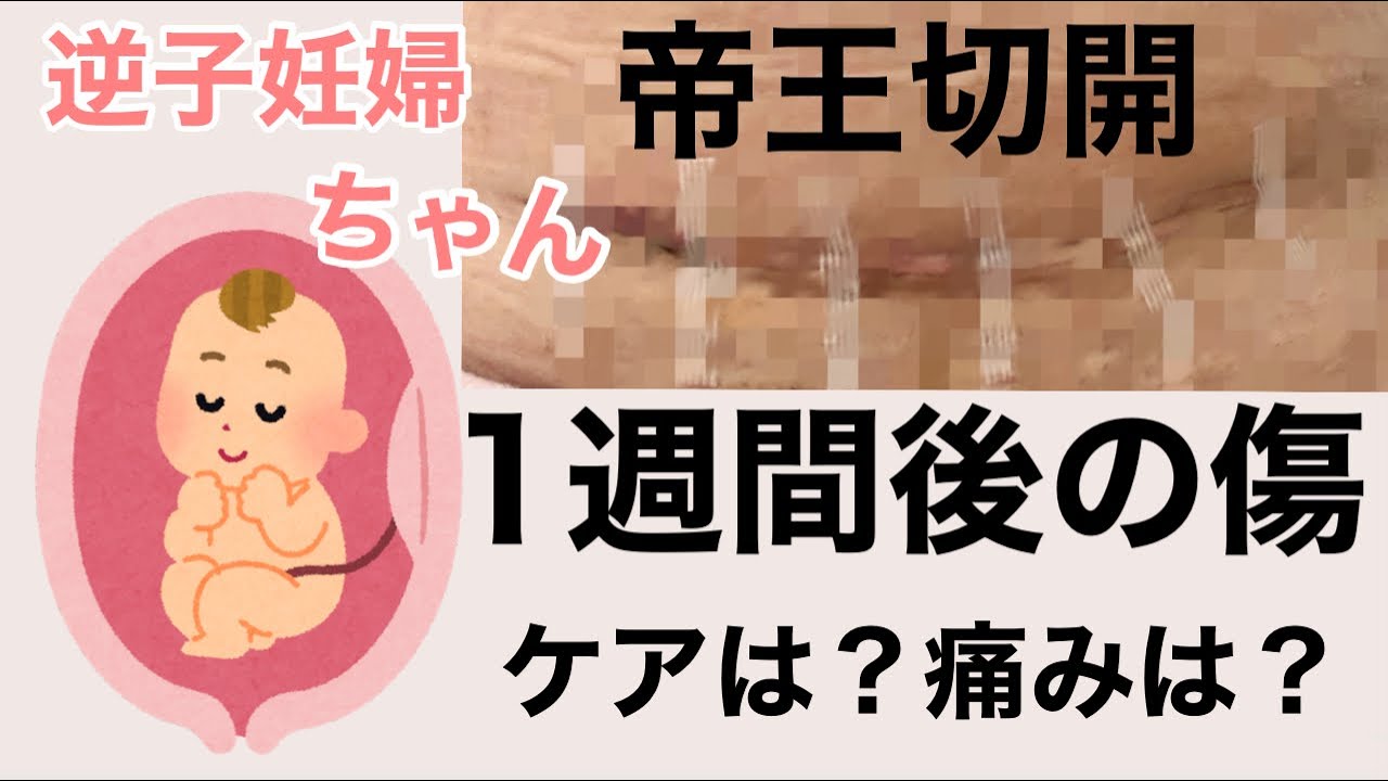 帝王切開1週間後の傷 Youtube