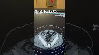 Cecal diverticulitis