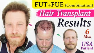 USA thin Donor Hair Transplant Result 6 MOs at Medispa By Dr Suneet | FUT + FUE + PRP