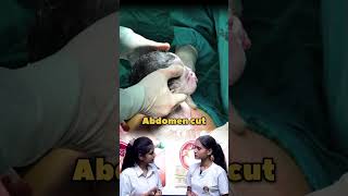 C-Section Delivery Kya Hoti Hai? 🤰 Normal Delivery Se Kitni Alag? Full Explained!