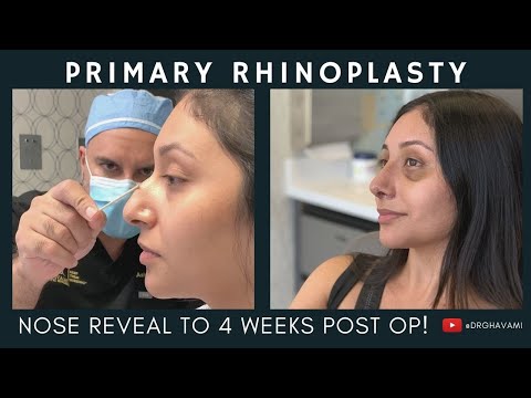Video thumbnail: Primary Rhinoplasty | Nose Reveal to 4 Weeks Post Op?! | Nose By Ghavami