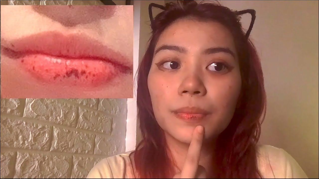 What’s my health condition? (Peutz-Jeghers Syndrome)