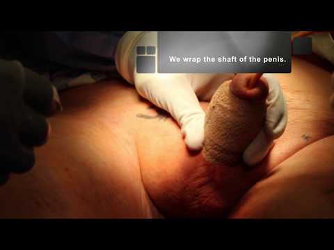 Video: Penis - Rødhet, Sykdom, Struktur