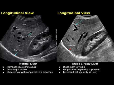Fatty Liver Grading On Ultrasound | USG Normal Vs Abnormal Images | Grades 1,2 & 3 Hepatic Steatosis