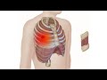 Intercostal Muscles | Chest Pain | Rib Pain | Trigger Points