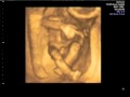 pregnancy ultrasound