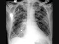 chest x-ray interpretation, pulmonary edema part 2, heart attack