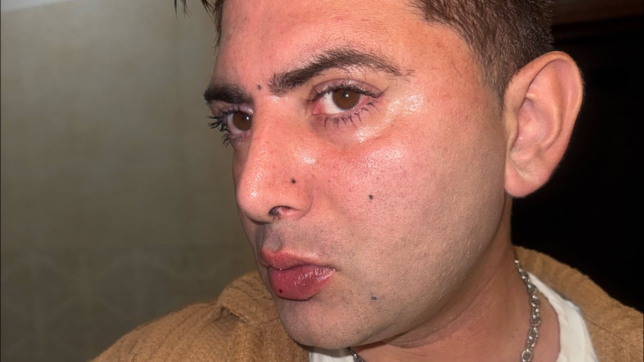 Different angle laser treatment