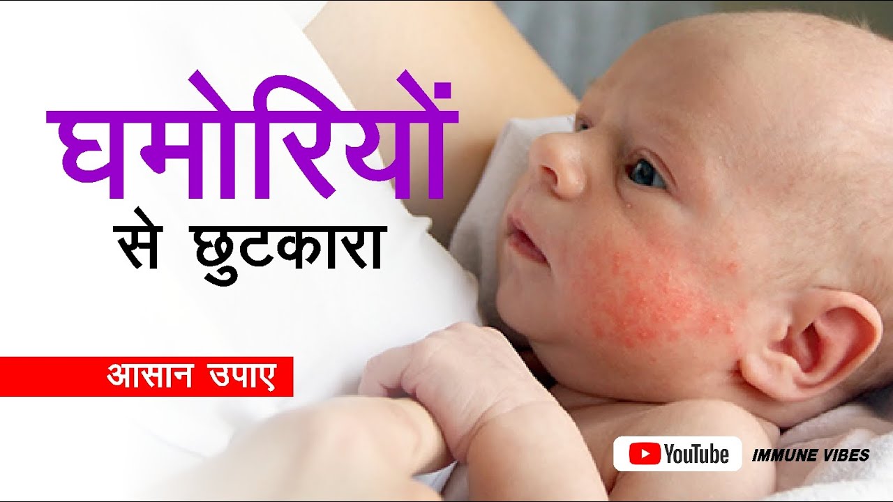 Ghamori ka ilaj ghamori ke liye kya karen heat rash 