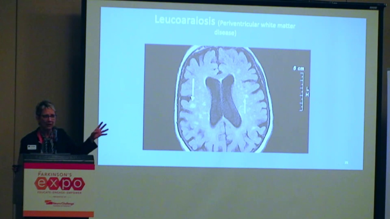 Memory Disorders & Dementia in Parkinson’s | Cheryl Brandi, APRN