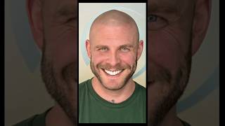 Scalp Micropigmentation by Marcin Adam, 1 of the most experienced SMP practitioners in the industry.