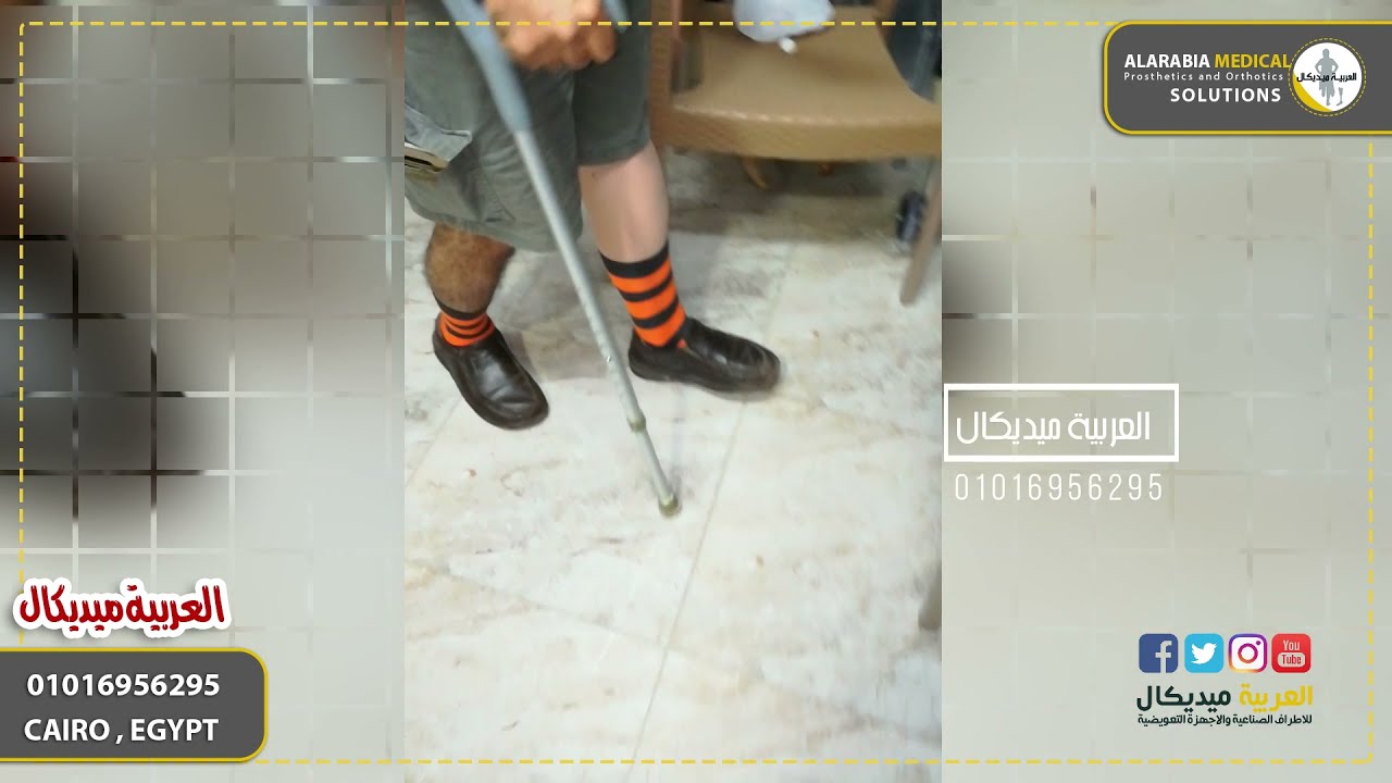 prosthetic above knee | تركيب طرف صناعي فوق الركبة