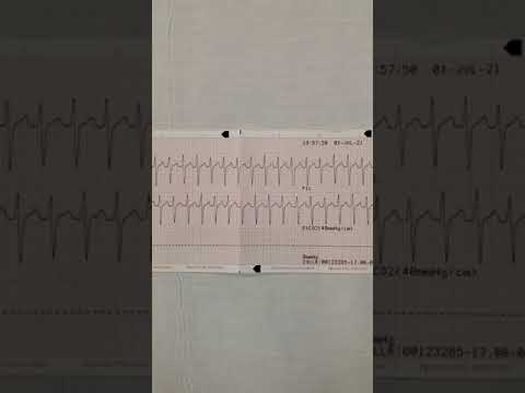 Video: Proč By Váš Lékař Mohl Objednat EKG