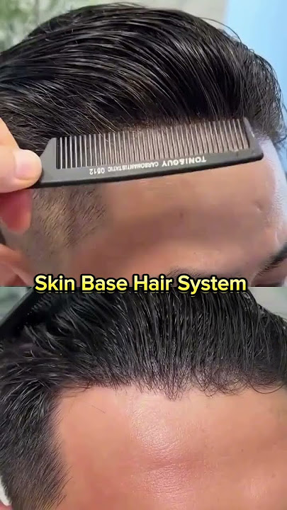 Skin Base Hair Patch System I 100 % Natural Look #hairreplacement #hairsystem