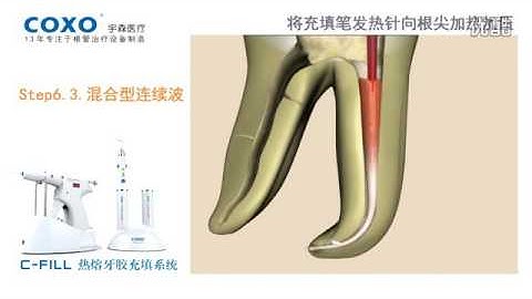 c-fill obturation system operation steps